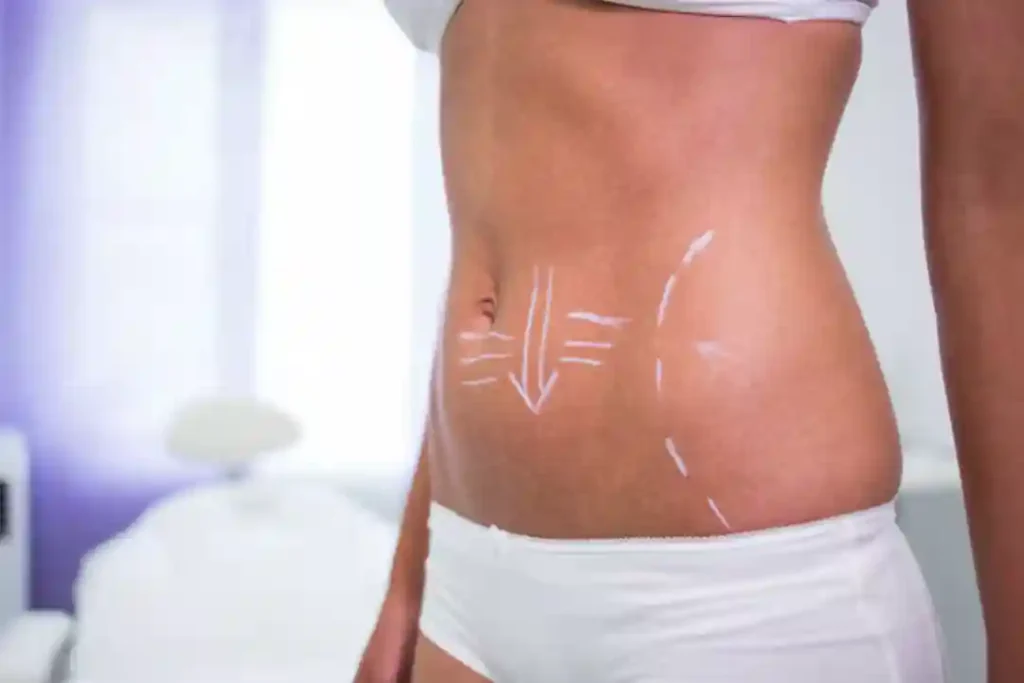 tummy tuck surgery